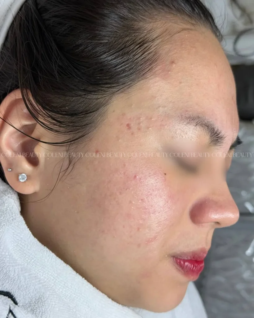 Clearer skin after PDT Acnes treatment at Coleni Beauty Da Nang