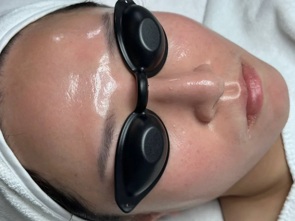 Before Skin Redness PDT treatment: redness on the cheeks, uneven skin tone, signs of sensitive and dehydrated skin