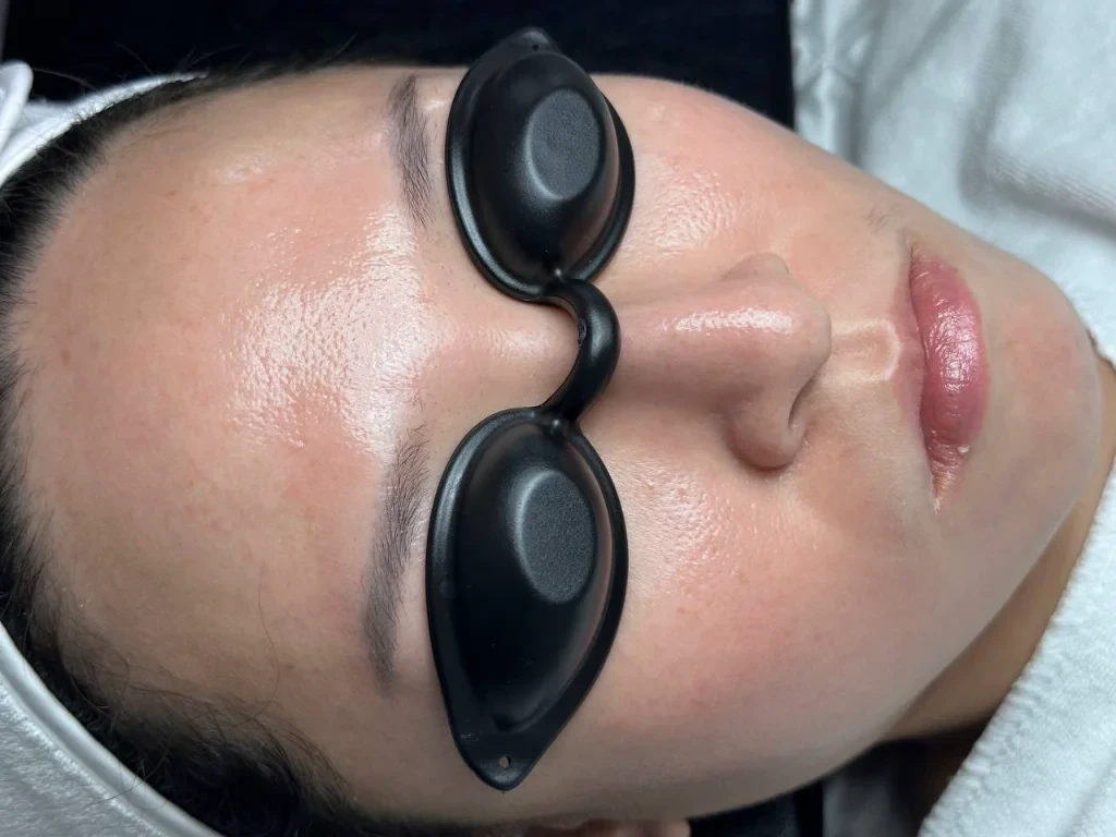 After 1 Skin Redness PDT session with the Skymedic Fotoage Mask: reduced redness patches, skin appears more stable and even-toned
