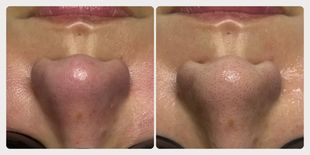 Clear blackheads and unclog pores after 1 session in Da Nang