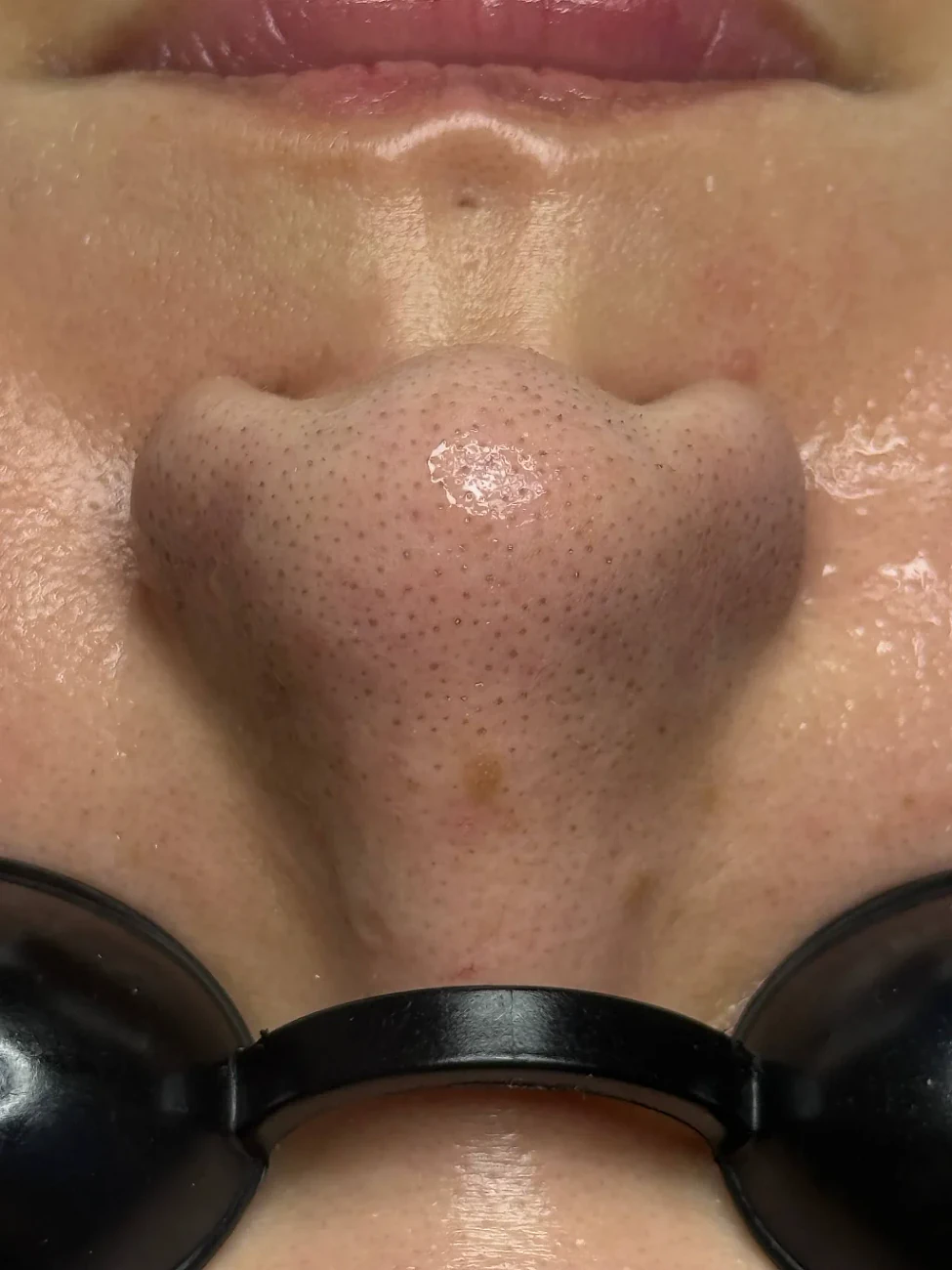 Before Deep Sebum Cleansing at Coleni Beauty Da Nang — nose clogged with sebum, dense blackheads, large pores