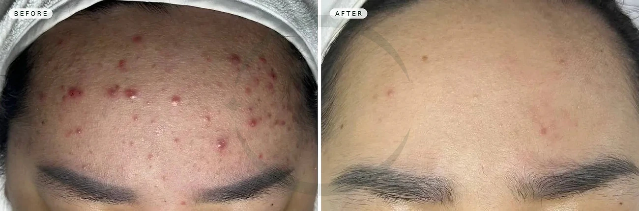 Forehead Inflammatory Acne Shows Clear Improvement After 3 Bio Acnes + PDT Acnes Sessions in Da Nang