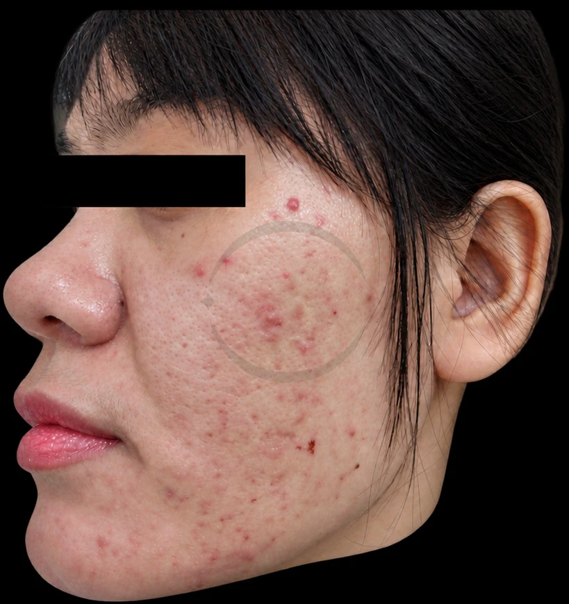 Female client's cheek with extensive red inflammatory acne and pustules before PDT Acnes treatment at Coleni Da Nang