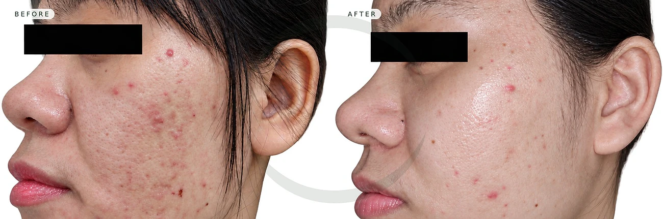Cheek Inflammatory Acne Improves Clearly After 5 PDT Acnes + Recovery Treatment Sessions in Da Nang